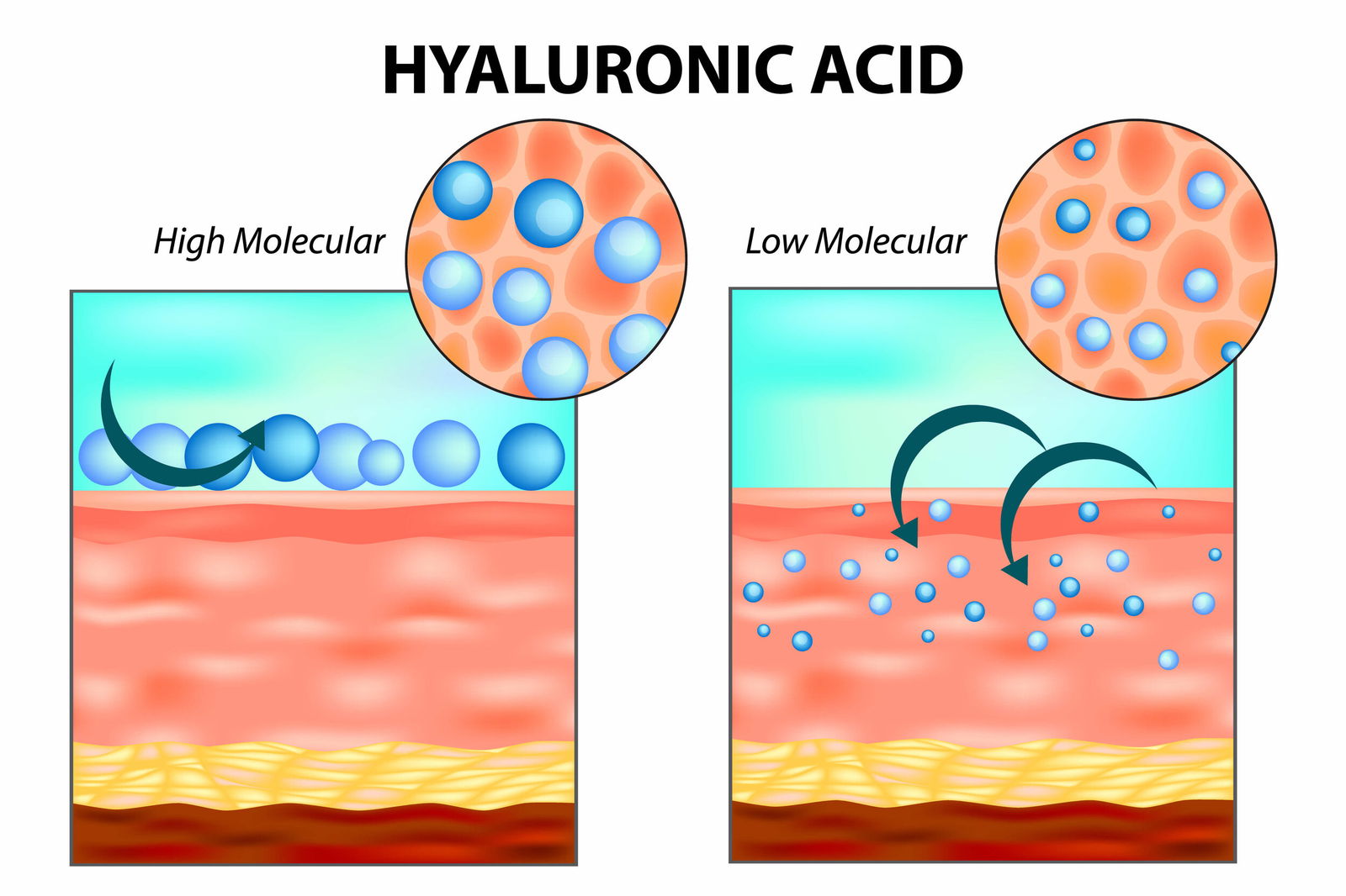 Various dermal filler products