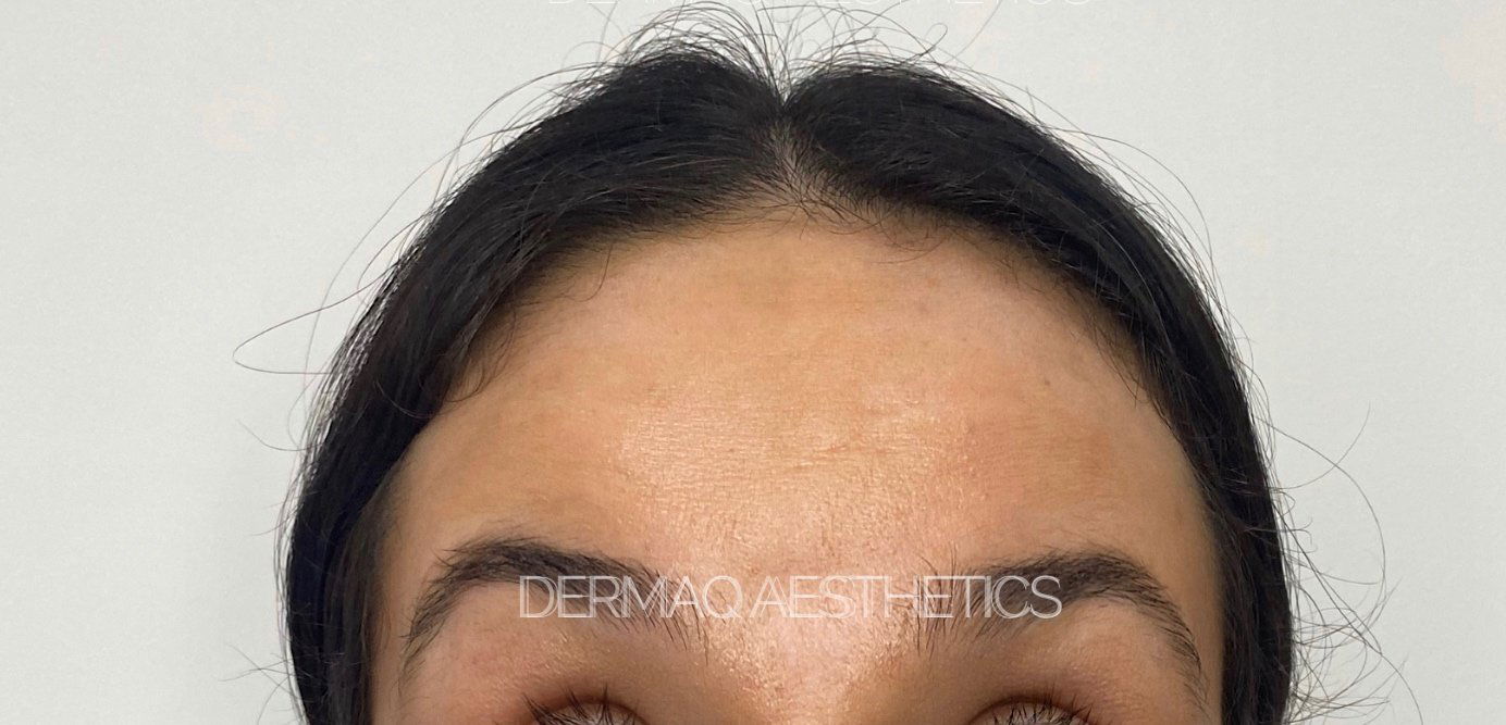 After anti-wrinkle treatment
