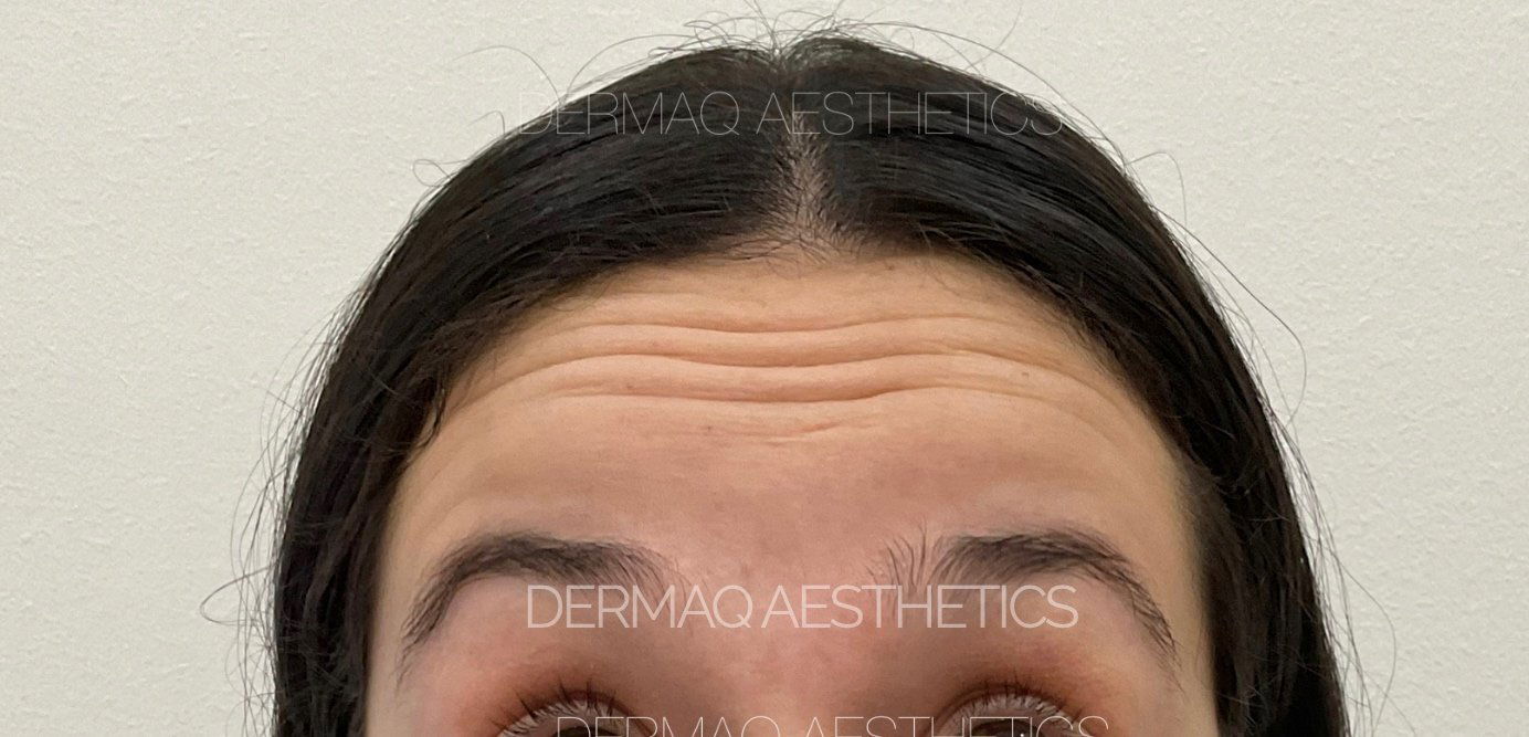 Before anti-wrinkle treatment