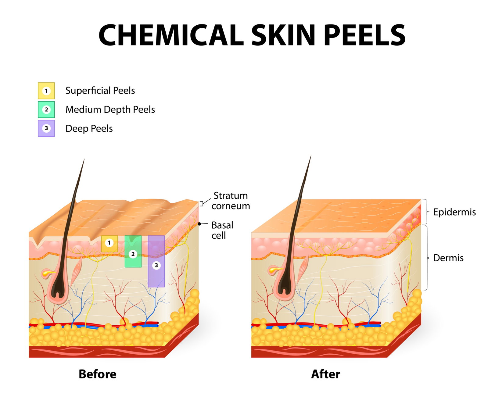 Chemical Peel Skin Diagram