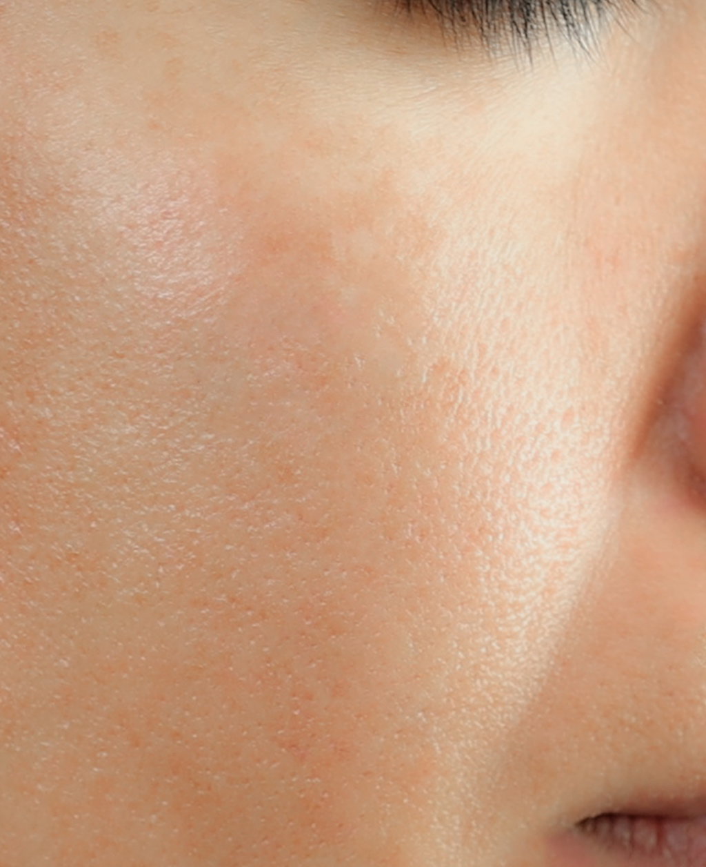 After Peel Treatment