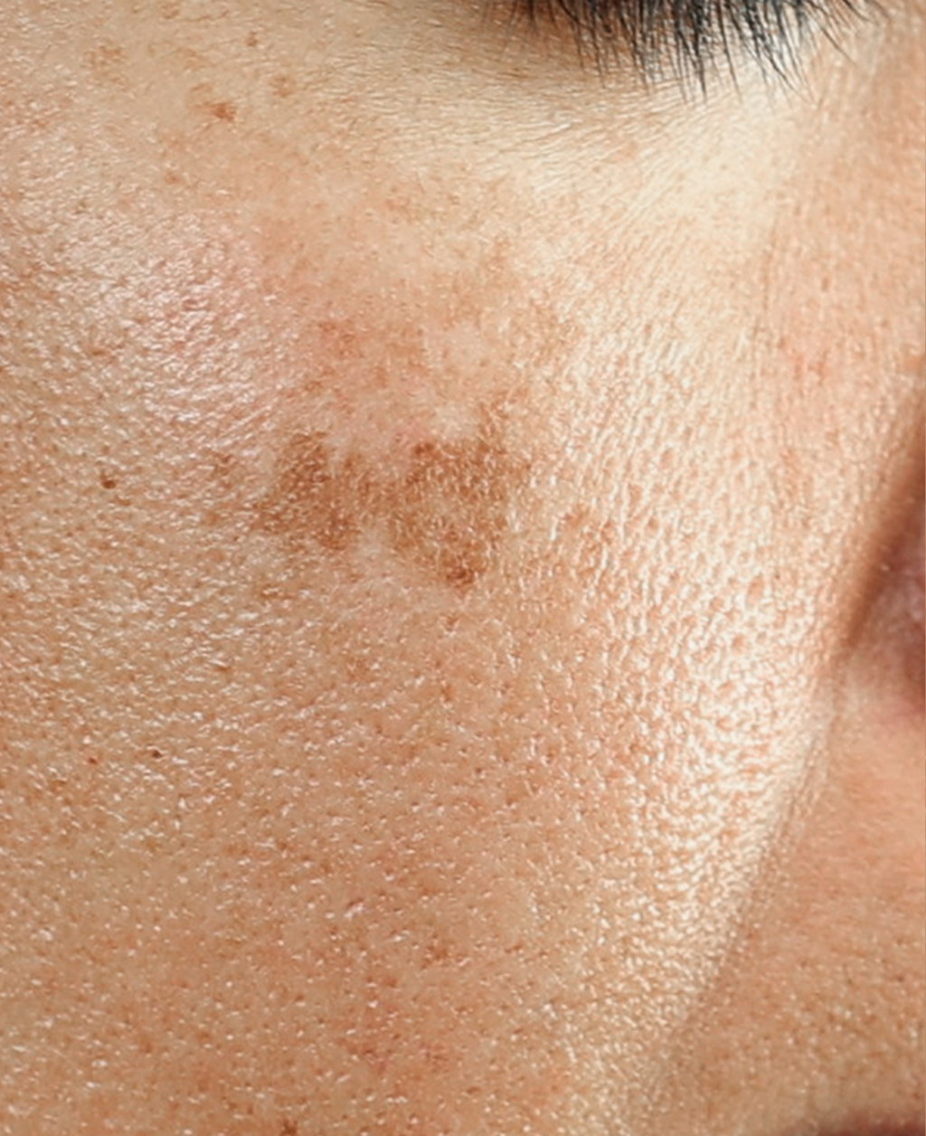 Before Peel Treatment