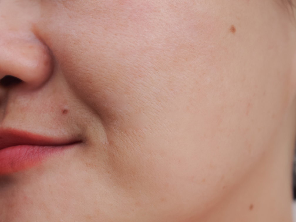 After Peel Treatment
