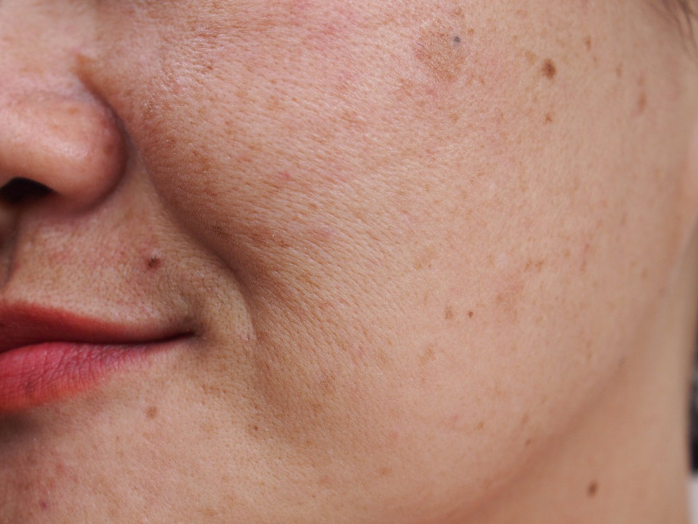 Before Peel Treatment