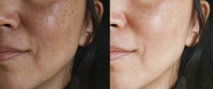 Before and after comparison of general skin improvement