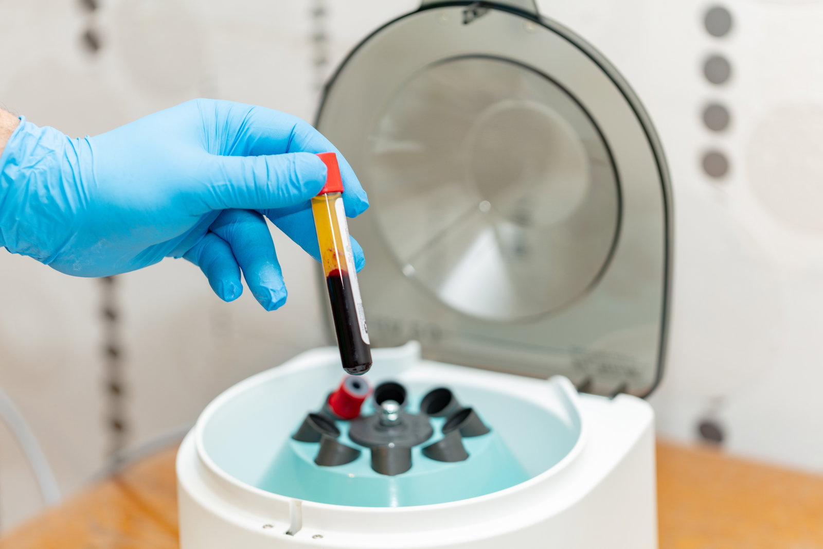 Blood sample processing for PRP hair restoration
