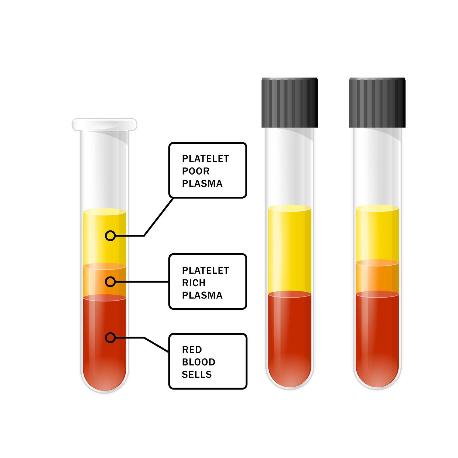 PRP plasma separation process showing platelet concentration