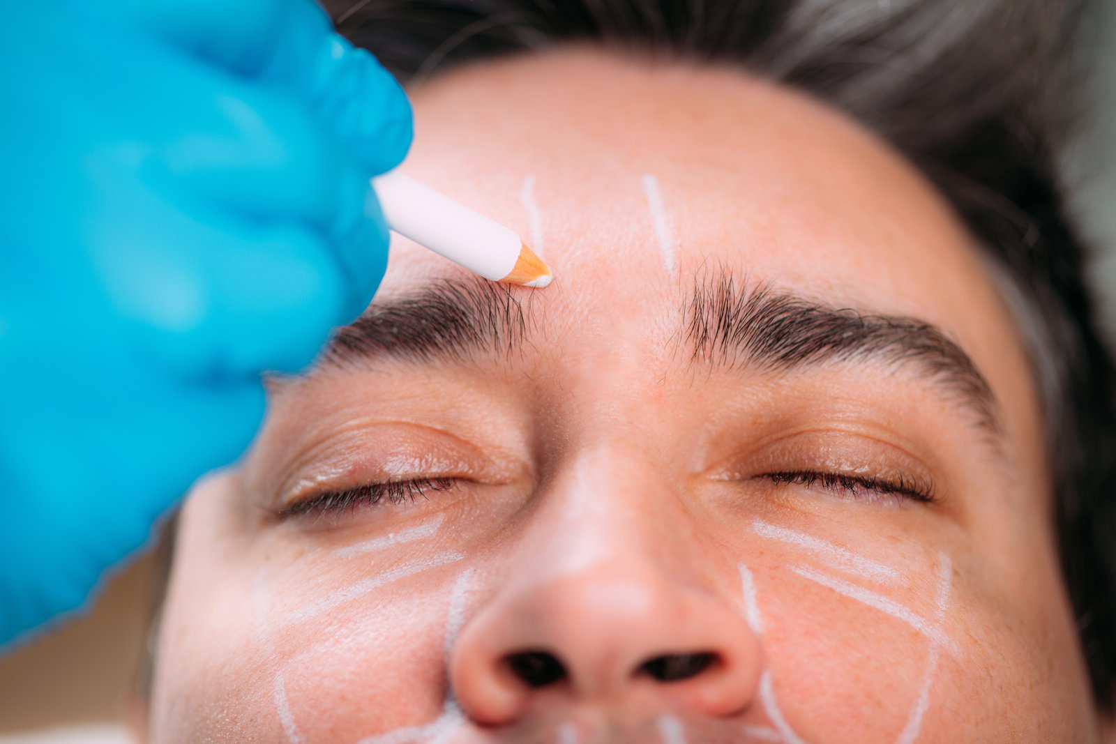 Facial Volume Loss in Men