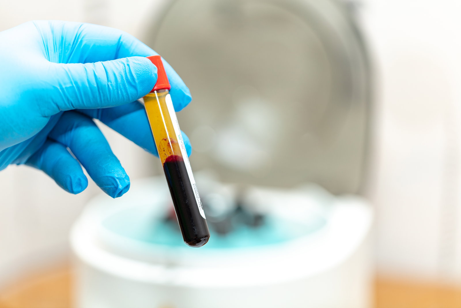 Precise blood sample preparation for PRP treatment