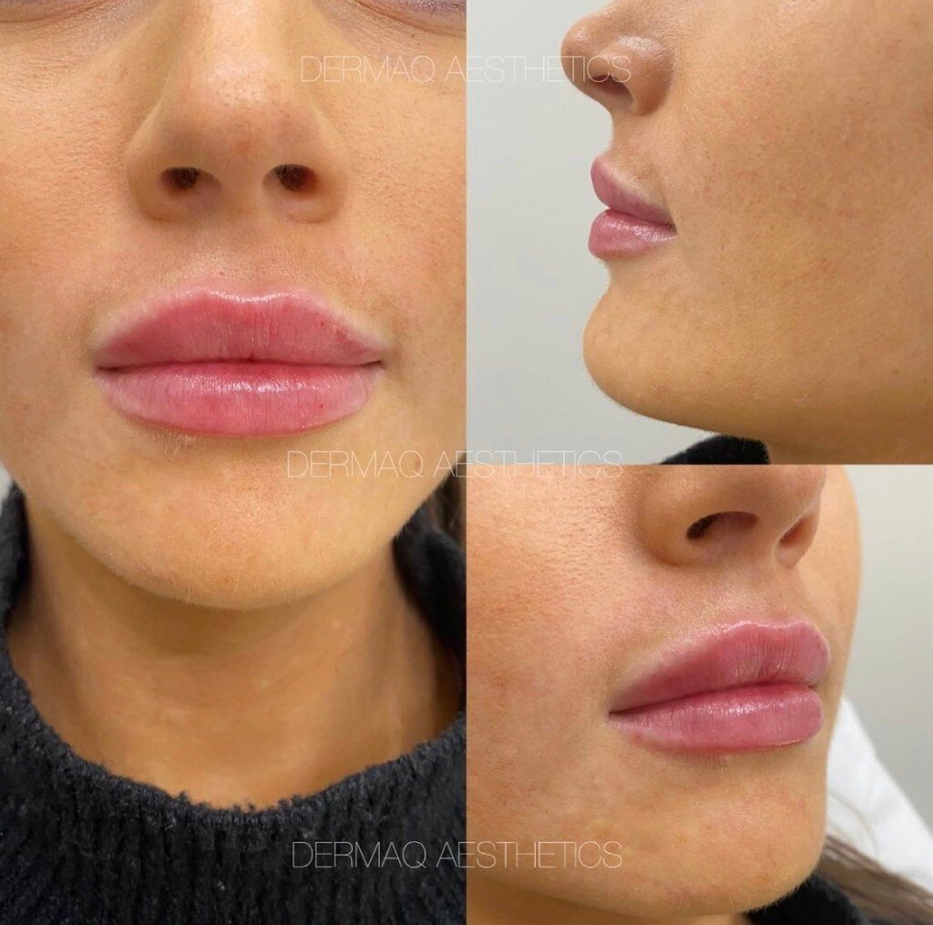 Lip transformation