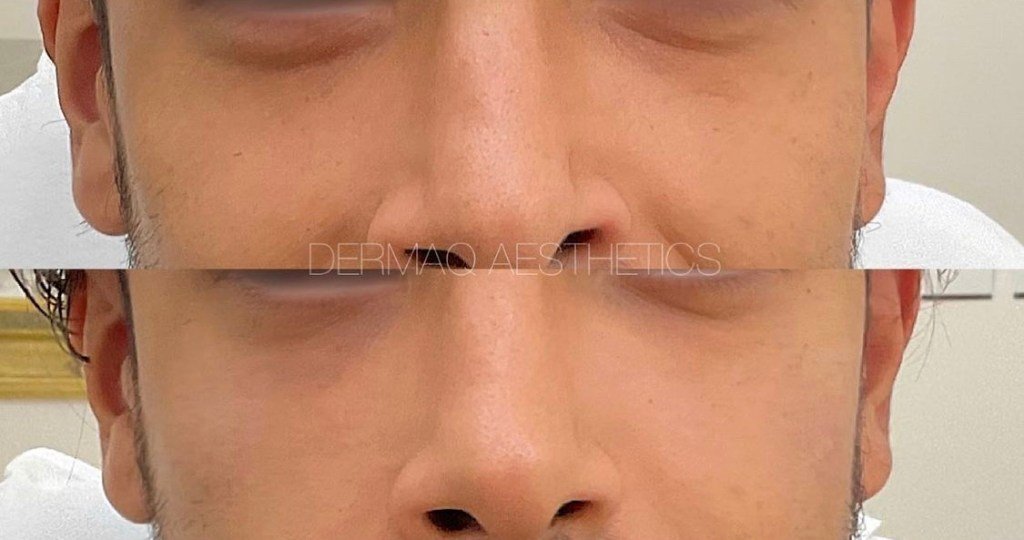 Under-eye filler result