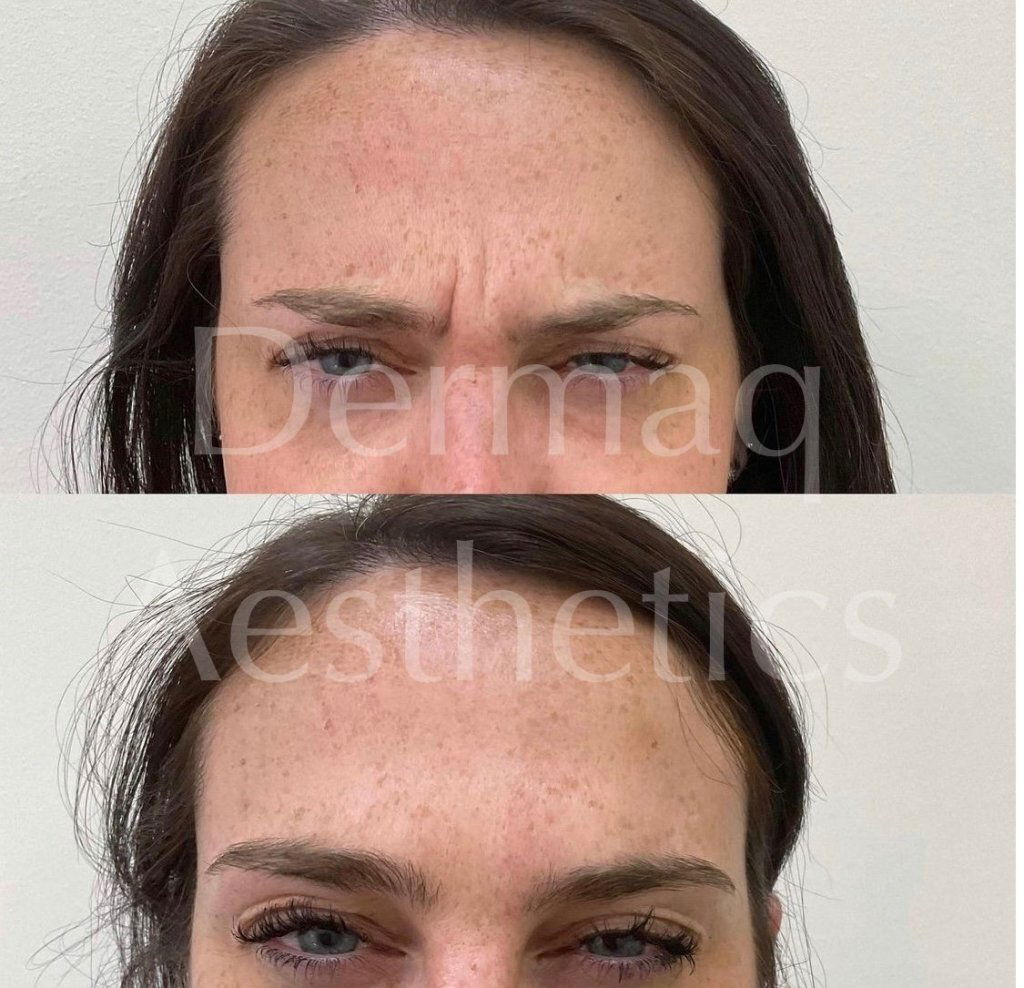 Before and after anti-wrinkle injections